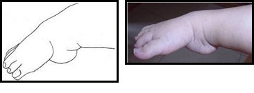 Компоненты косолапости