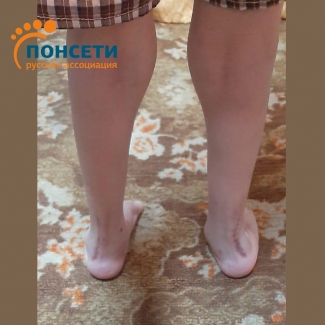 рецидив косолапости рецидив косолапости