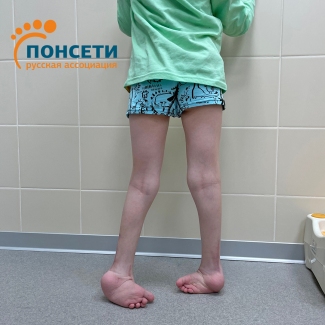 рецидив косолапости