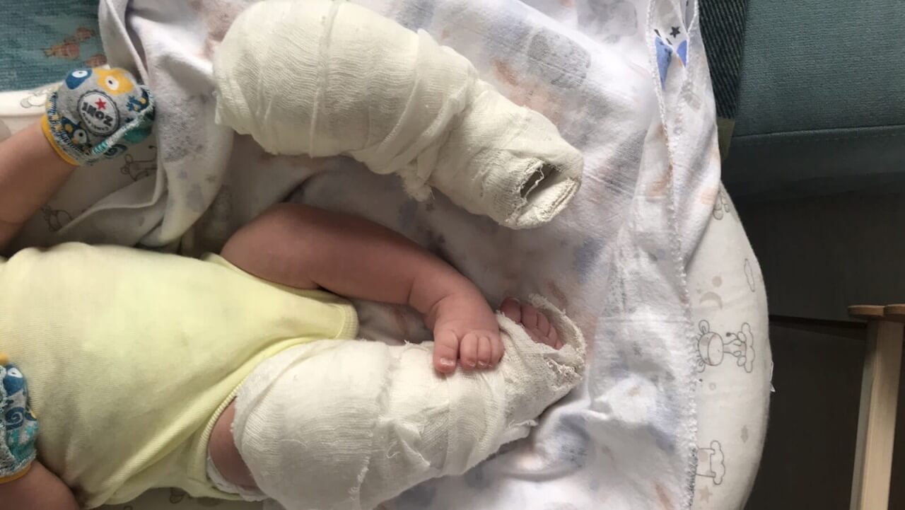 Врожденная атипичная косолапость